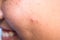 Dermatological disease acne pimples on the face of a teen boy