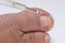 dermatologist, dermatovenereologist, podologist treats damaged rude nail on big toe of female foot, exfoliation, nail fungus,
