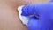 A dermatologist, a doctor, smears a scar from a mole just removed from the back of a person with an antiseptic. 4k