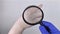 A dermatologist examines dry skin with a magnifying glass. Dry hands and peeling of the skin, mycosis. The girl shows her hands to