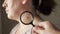 Dermatologist examines a mole on the patient`s neck using a magnifying glass