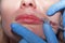 Dermatologist performs contour plastic in the lips with filler