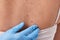 Dermatologist in rubber glove examining patient\'s birthmark, closeup view