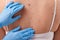 Dermatologist in rubber gloves examining patient\'s birthmark