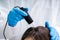 Dermatologist Using Trichoscope For Hair Fall Treatment