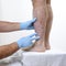 The dermatologist visits an adult man with psoriasis in the legs