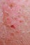 Dermatology professionals often encounter cases of a psoriatic eczema in their practice.