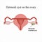 Dermoid cyst on the ovary. . Infographics. Vector illustration