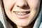 Design of braces on teeth. Beautiful caucasian young girl in dental braces smiles in sun. Teenage concept. Problematic skin with