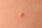 Detail of a molluscum contagiosum nodule produced by the Molluscipoxvirus virus on the skin of the abdomen of a child