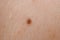 Detailed view of the nevus mole and the texture of human skin.