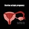 Development of the embryo in the ovary. Ectopic pregnancy. Infographics. Vector illustration