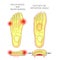 Deviation of the first and the fifth metatarsals transverse flat