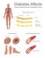 Diabetes affects the nerves and vessels.