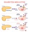 Diabetes mellitus as high blood sugar and metabolic illness outline diagram