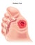 Diabetic foot