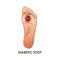 Diabetic Foot. Defeat, ulcer, skin sores on foot