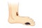 Diabetic Foot Pain and Ulcers.