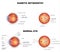 Diabetic retinopathy