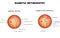 Diabetic retinopathy