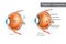 Diabetic retinopathy. Difference between Normal Retina and Diabetic Retinopathy