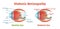 Diabetic Retinopathy vector illustration diagram, anatomical scheme.