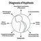 Diagnosis of kyphosis. Spinal curvature, kyphosis, lordosis, scoliosis, arthrosis. Improper posture and stoop