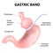 Diagram of an adjustable gastric band