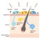 Diagram of body odor and sweat glands. Human skin layer illustration for medical and health care use