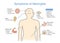 Diagram to showing patient symptoms with Meningitis disease.