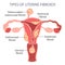 Diagram of types of uterine fibroids in a woman on a white background. Genicolgia. Medical concept. Infographic banner.