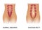 Diastasis recti