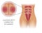 Diastasis Recti repair