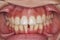 Diastema gap between lower central incisors