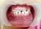 The diastema teeth on child