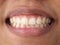 Diastema between the upper incisors