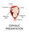 Different baby positions in the uterus during pregnancy