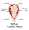 Different Placental Locations During Pregnancy. Major and Normal placenta previa, total and partial.