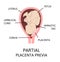 Different Placental Locations During Pregnancy. Major and Normal placenta previa, total and partial