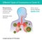 Different Types of Coronavirus or Covid-19.