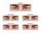 Different types of strabismus.