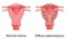 Diffuse Adenomyosis Human anatomy Female Sick vs normal reproductive system organs. Location Cross section scheme uterus