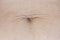 Dilated navel after losing weight and pregnancy. hanging skin close-up.