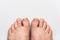 Dirty, uncut and broken toe nails, top view, gray background, health and care