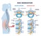 Disc herniation or spine nerve compression vs healthy anatomy outline diagram