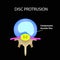 Disc protrusion. Top view. Spine. Infographics. Vector illustration on a black background