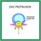 Disc protrusion. Top view. Spine. Infographics. Vector illustration on isolated background