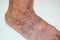 Disease varicose veins