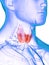 A diseased thyroid gland