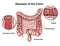 Diseases of the colon 3d medical  illustration on white background